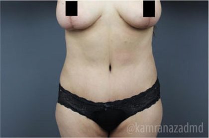 Tummy Tuck Before & After Patient #2828