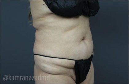 Tummy Tuck Before & After Patient #2828