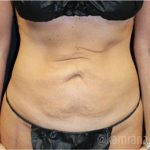 Tummy Tuck Before & After Patient #2829