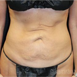 Tummy Tuck Before & After Patient #2829