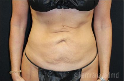Tummy Tuck Before & After Patient #2829