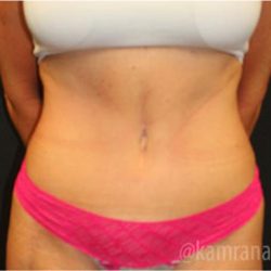 Tummy Tuck Before & After Patient #2829