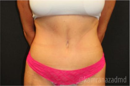 Tummy Tuck Before & After Patient #2829