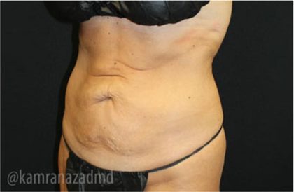 Tummy Tuck Before & After Patient #2829