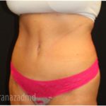Tummy Tuck Before & After Patient #2829