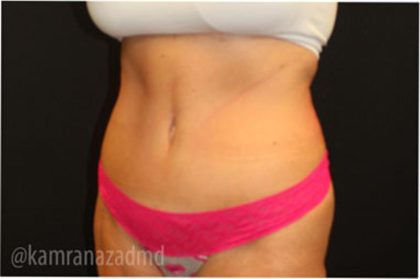 Tummy Tuck Before & After Patient #2829