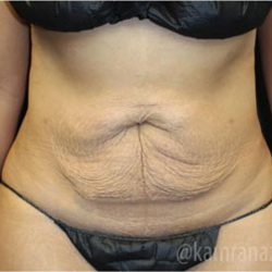 Tummy Tuck Before & After Patient #2830
