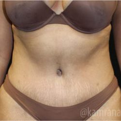 Tummy Tuck Before & After Patient #2830
