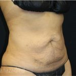 Tummy Tuck Before & After Patient #2830