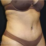 Tummy Tuck Before & After Patient #2830