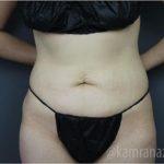 Tummy Tuck Before & After Patient #2831