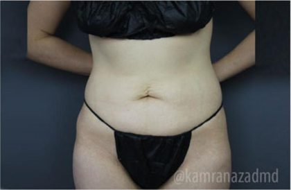 Tummy Tuck Before & After Patient #2831
