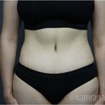 Tummy Tuck Before & After Patient #2831