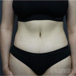Tummy Tuck Before & After Patient #2831