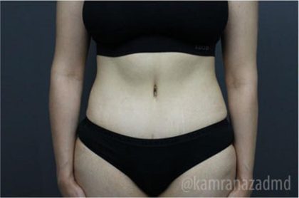 Tummy Tuck Before & After Patient #2831
