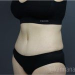 Tummy Tuck Before & After Patient #2831