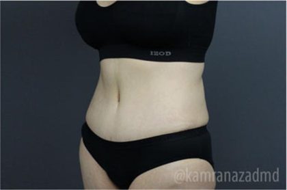 Tummy Tuck Before & After Patient #2831