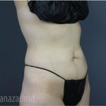 Tummy Tuck Before & After Patient #2831