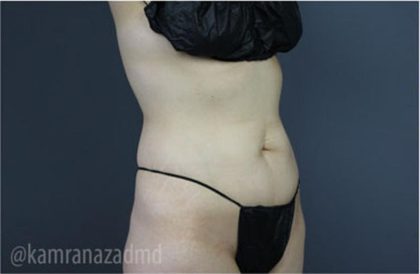 Tummy Tuck Before & After Patient #2831