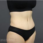 Tummy Tuck Before & After Patient #2831