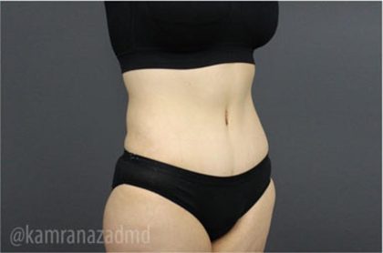 Tummy Tuck Before & After Patient #2831