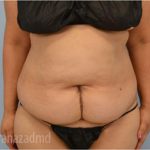 Tummy Tuck Before & After Patient #2832