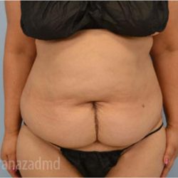 Tummy Tuck Before & After Patient #2832