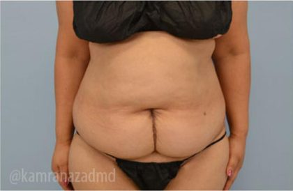 Tummy Tuck Before & After Patient #2832