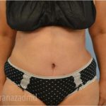 Tummy Tuck Before & After Patient #2832