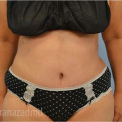 Tummy Tuck Before & After Patient #2832
