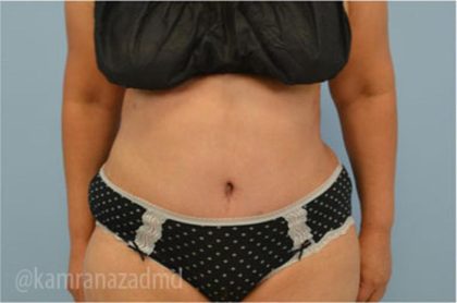 Tummy Tuck Before & After Patient #2832