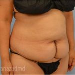 Tummy Tuck Before & After Patient #2832