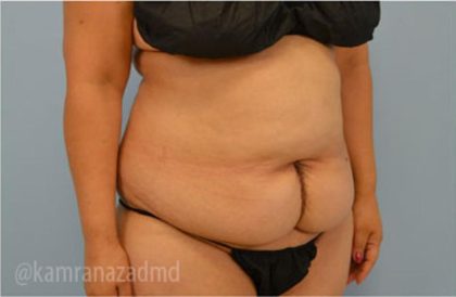 Tummy Tuck Before & After Patient #2832