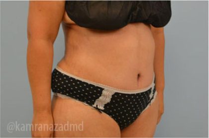 Tummy Tuck Before & After Patient #2832