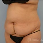 Tummy Tuck Before & After Patient #2832