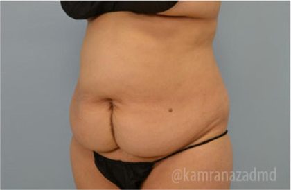 Tummy Tuck Before & After Patient #2832