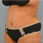 Tummy Tuck Before & After Patient #2832