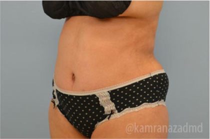 Tummy Tuck Before & After Patient #2832