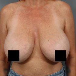 Breast Lift Before & After Patient #3202