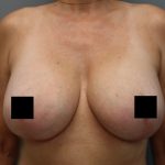 Breast Lift Before & After Patient #3202