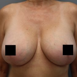Breast Lift Before & After Patient #3202