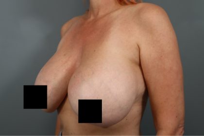 Breast Lift Before & After Patient #3202