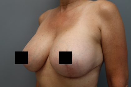 Breast Lift Before & After Patient #3202