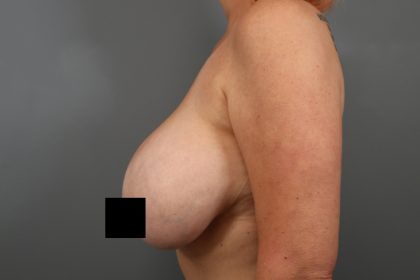 Breast Lift Before & After Patient #3202