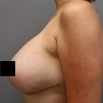 Breast Lift Before & After Patient #3202