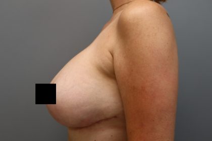 Breast Lift Before & After Patient #3202