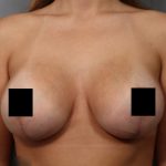 Breast Lift Before & After Patient #3187