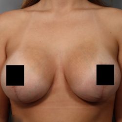 Breast Lift Before & After Patient #3187