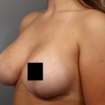 Breast Lift Before & After Patient #3187