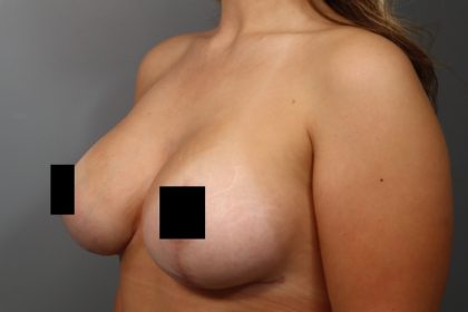 Breast Lift Before & After Patient #3187